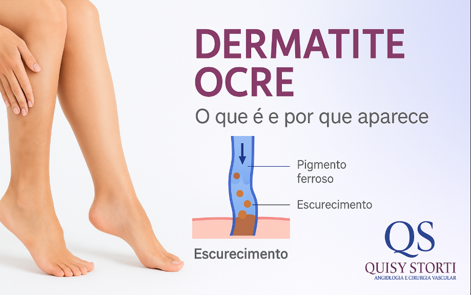 Manchas nas pernas causadas por má circulação